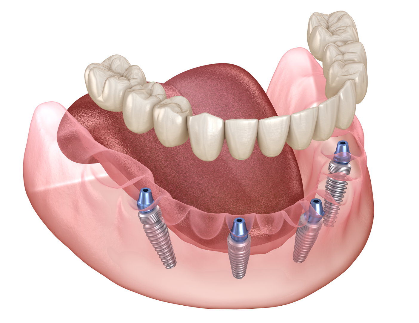 implant1